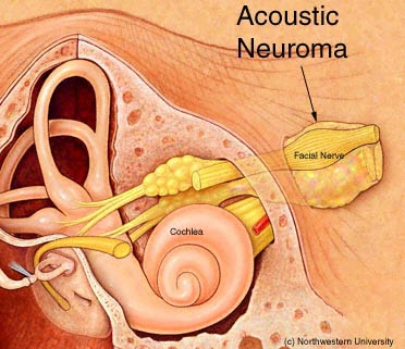 acoustic neuroma