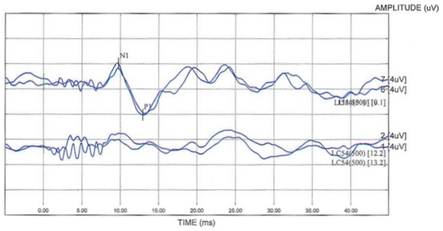 Il video head impulse test (vHIT)