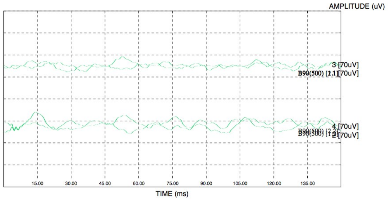 Il video head impulse test (vHIT)