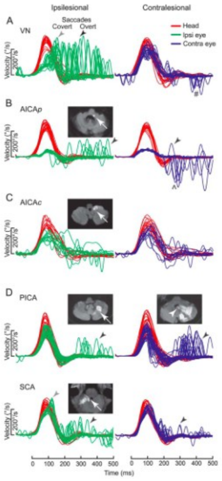 Il video head impulse test (vHIT)