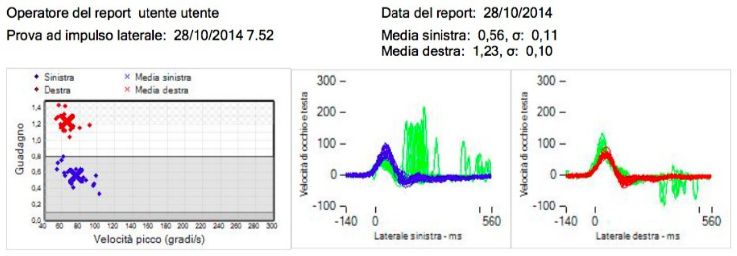 Il video head impulse test (vHIT)